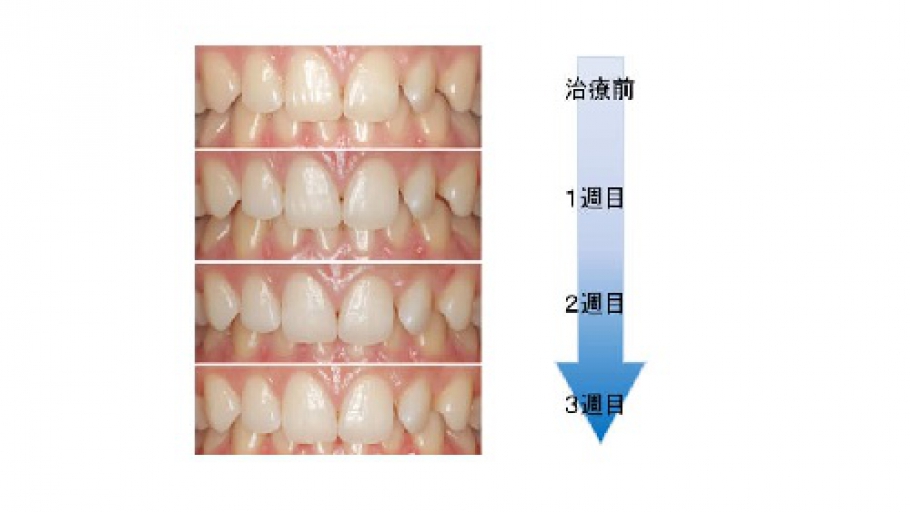 歯のホワイトニング(光触媒) | 東京都港区の美容室 フラップ「FRAP」 | 東京都港区の美容室 フラップ「FLAP」